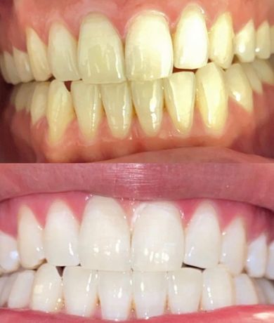 découvrez les meilleures options de blanchiment dentaire à grenoble pour une sourire éclatant. nos professionnels expérimentés vous garantissent un traitement sûr et efficace pour révéler la beauté de vos dents.