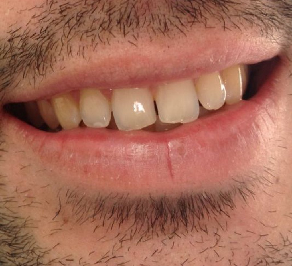 découvrez nos services de blanchiment dentaire à grenoble pour un sourire éclatant et éclatant. profitez de traitements professionnels adaptés à vos besoins et obtenez des résultats visibles rapidement. prenez rendez-vous dès aujourd'hui !